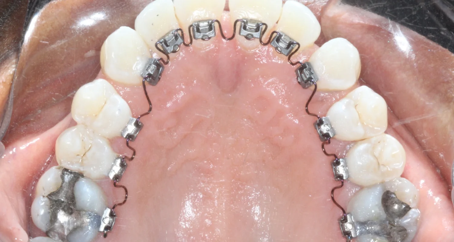 2 - ¿Qué son los brackets linguales