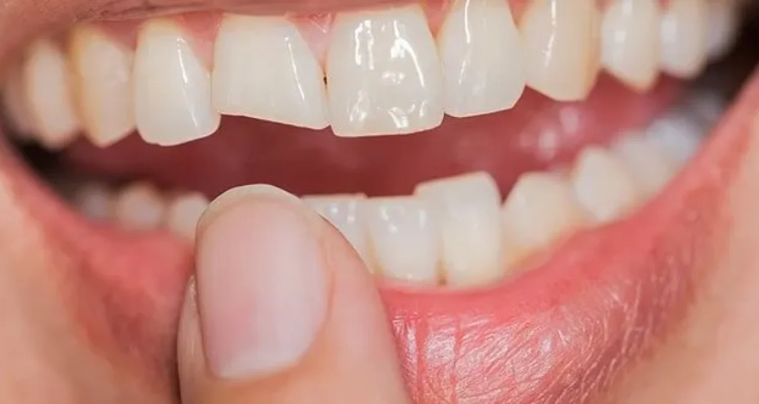 2 - What Is Dental Attrition