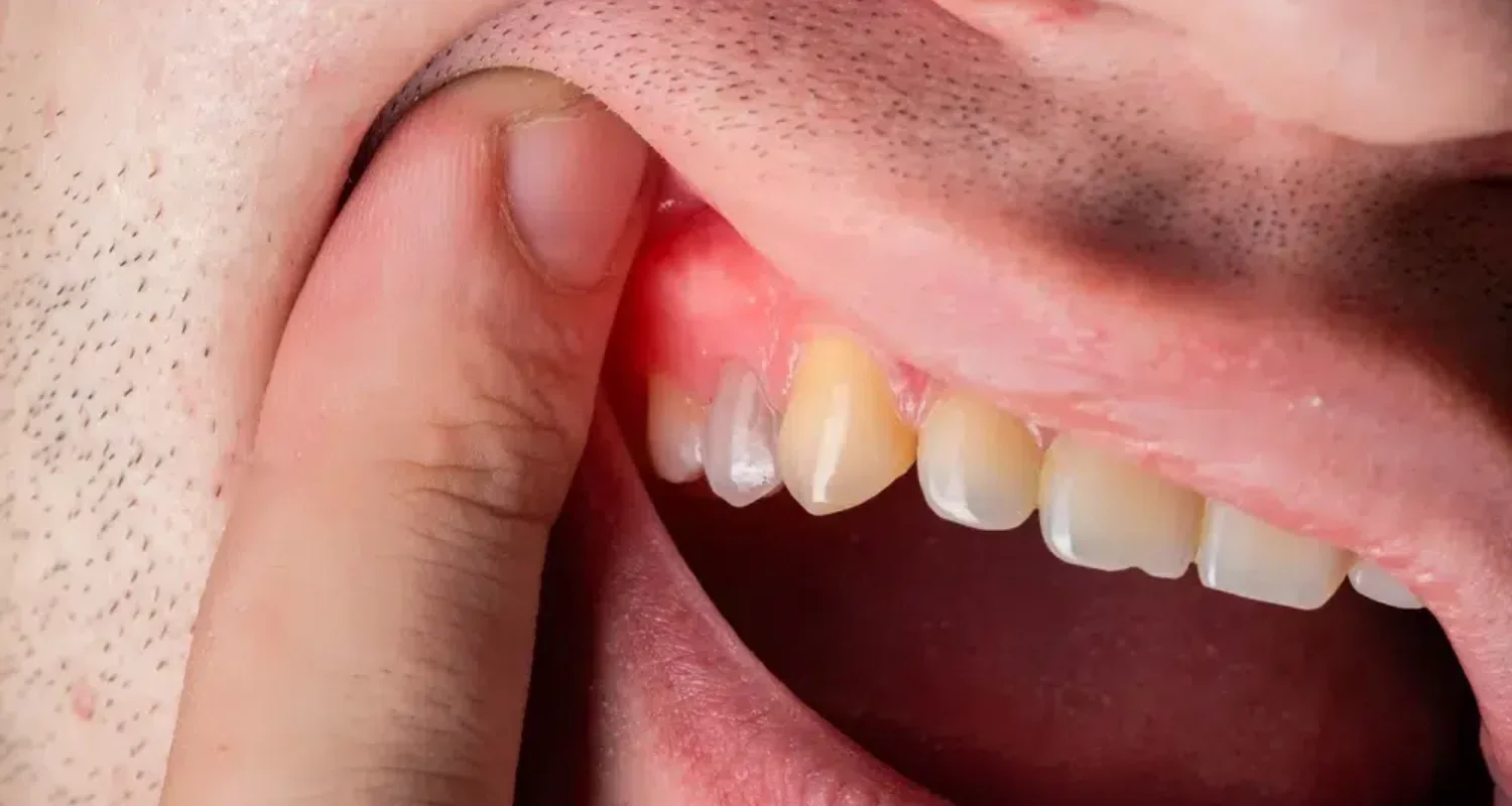 2 - What is a tooth infection_ - Natural Antibiotics for Tooth Infection