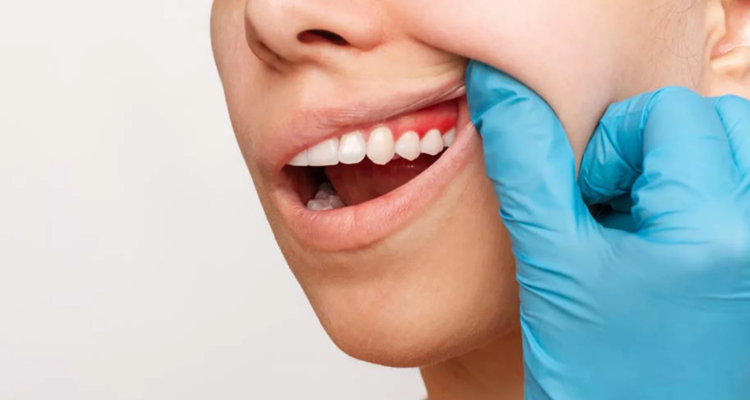 2 - What is gum graft surgery