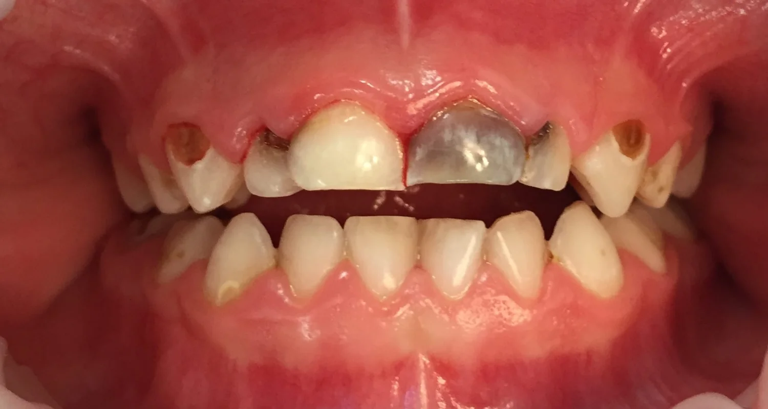 3 - Causes of Tooth Infections - Natural Antibiotics for Tooth Infection