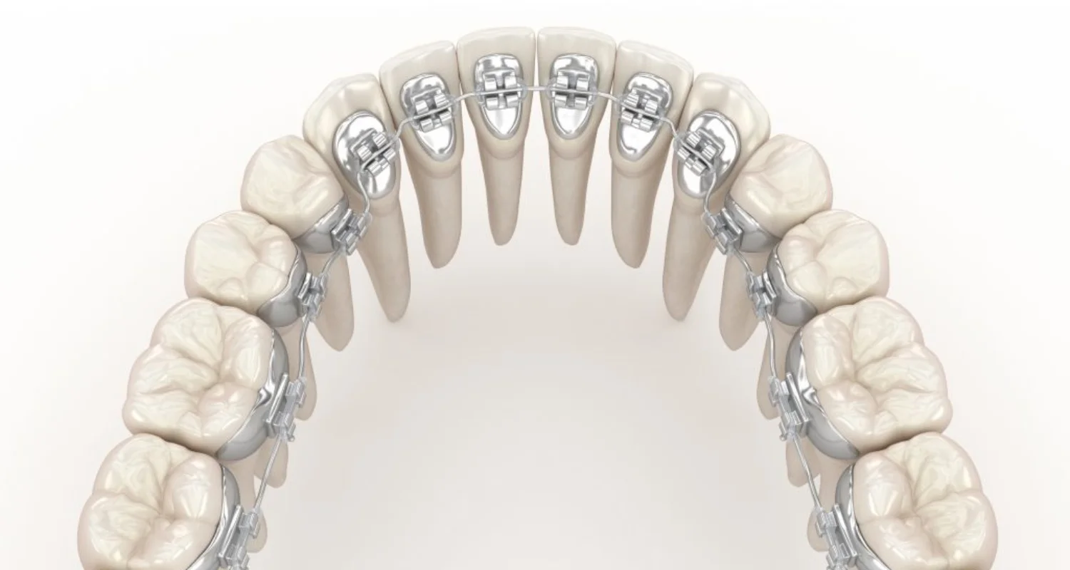 3 - Lingual Braces Options