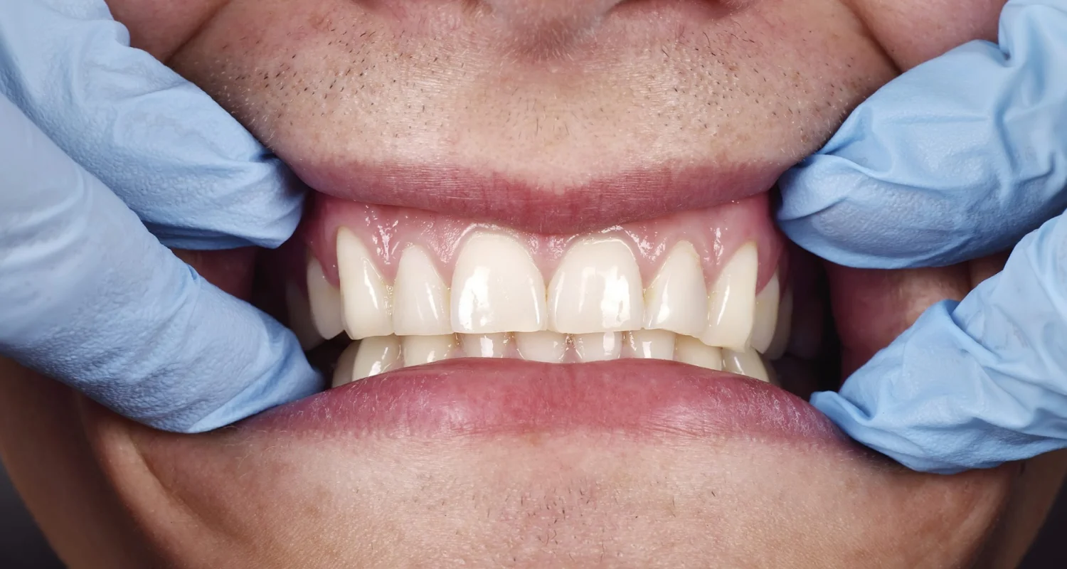 4 - Who Might Need Gum Graft Surgery