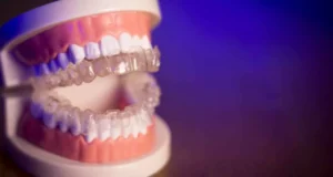 5 - Are Lingual Braces Better than Clear Aligners