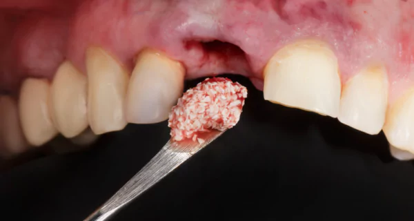 bone graft in mouth