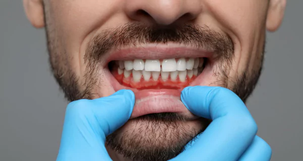 Gingivitis vs. Periodontitis