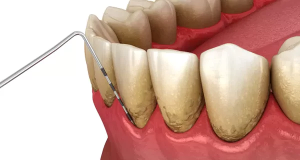 gum-disease-causes