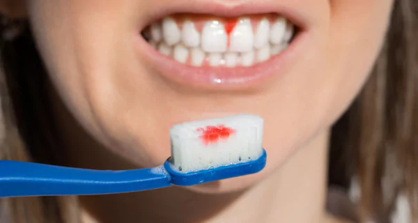 gum disease treatment at home