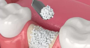 qué es un injerto de hueso dental y cómo recuperarse