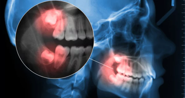 ¿Por qué ocurre el dolor de cuello por muela del juicio?