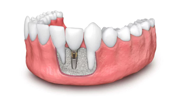 tipos de injertos de hueso dental