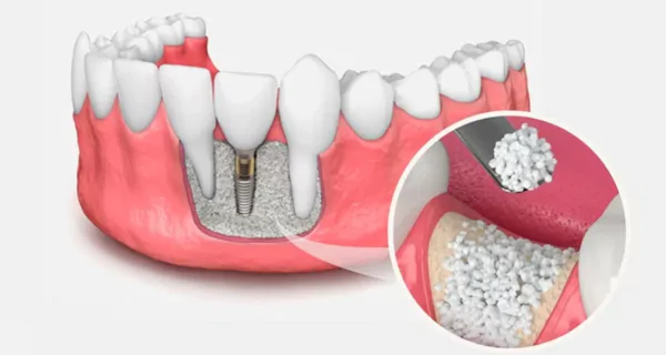 Bone Graft in Mouth: Complete Guide to Procedure & Recovery