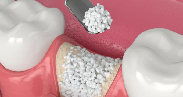 what-is-a-bone-graft-in-dentistry