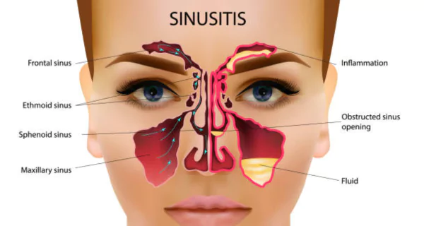 Toothache and Sinus Infection: Causes, Symptoms, and Relief