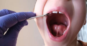 1 - Sore Lingual Frenulum_ Top 5 Causes and Solutions