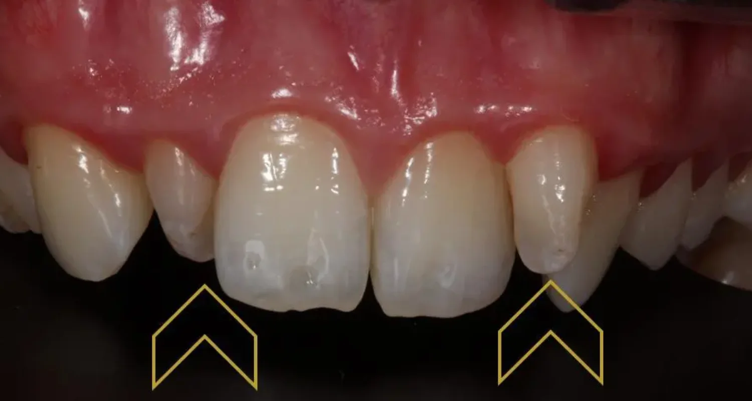 2 - ¿Qué son los dientes en clavija