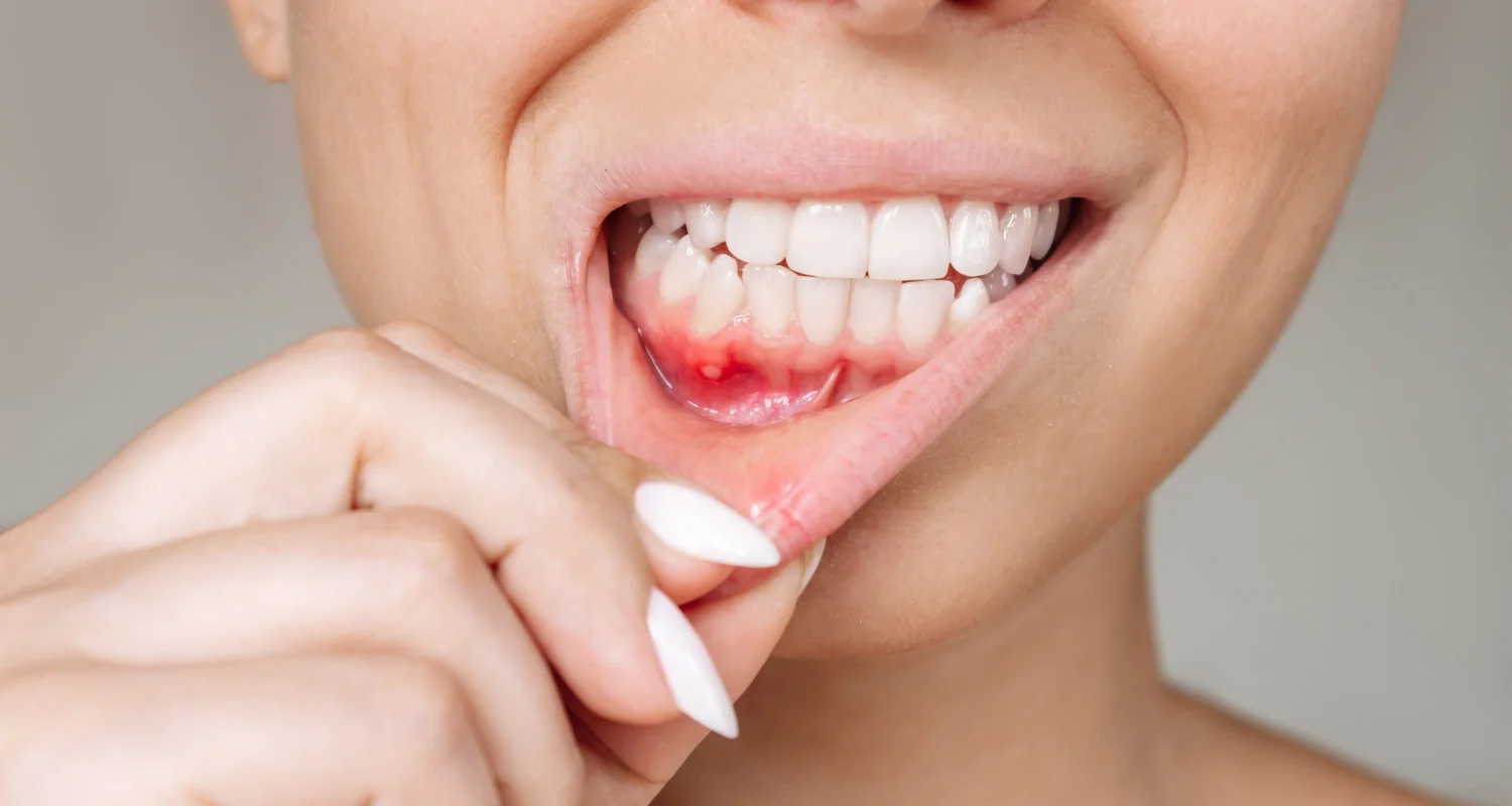 2 - What are gum infections_ - natural antibiotics for gum infection