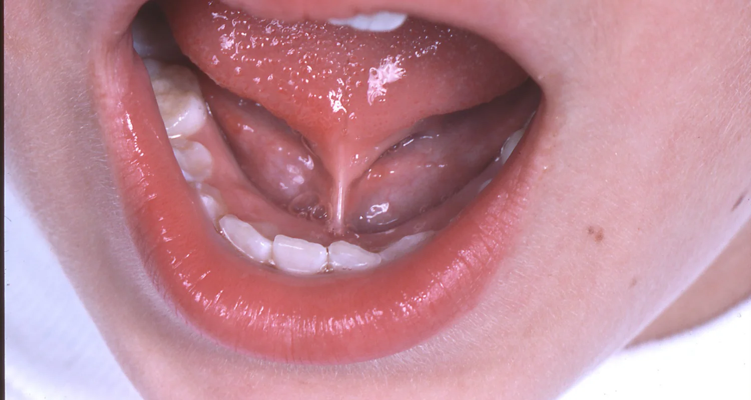 2 - What is the frenulum_ - sore lingual frenulum