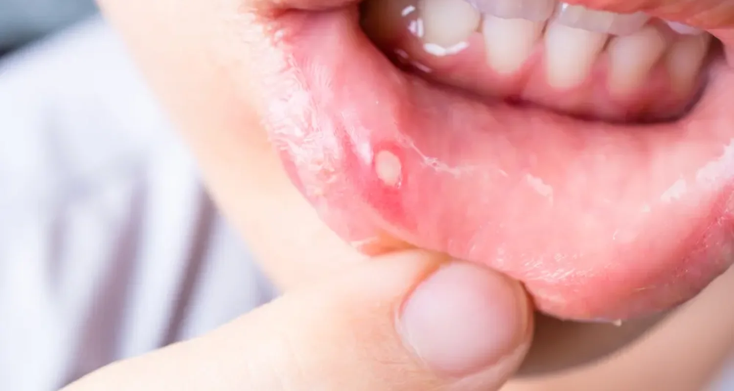 3 - Causes of a sore lingual frenulum