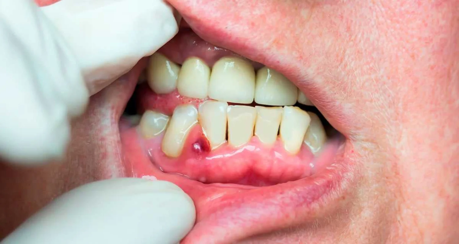 3 - Periodontitis Cuando el problema avanza - Antibióticos naturales para las encías