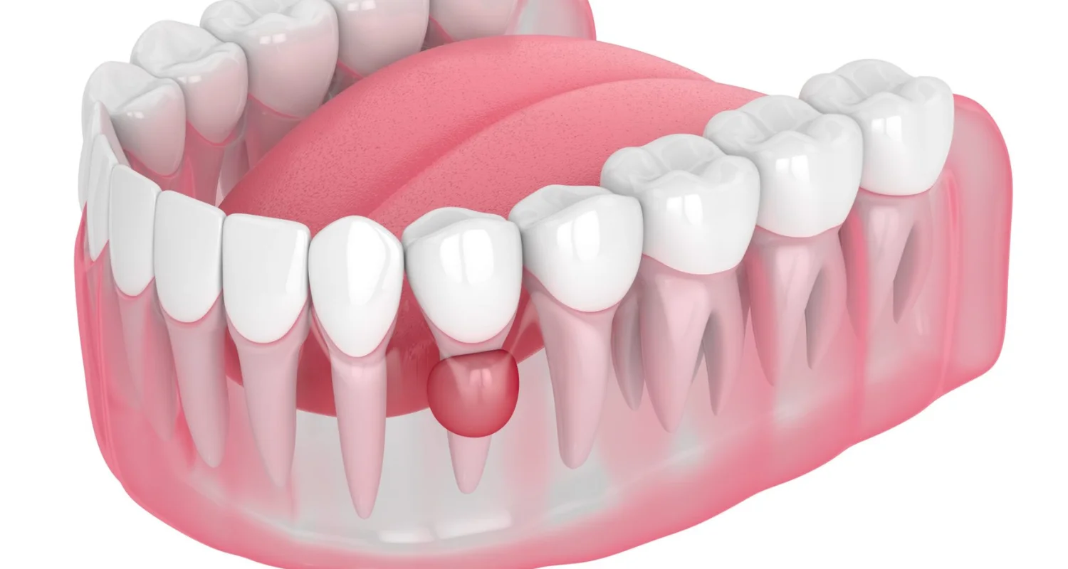 3 - Tooth Fusion (Ankylosis) - milk teeth in adulthood