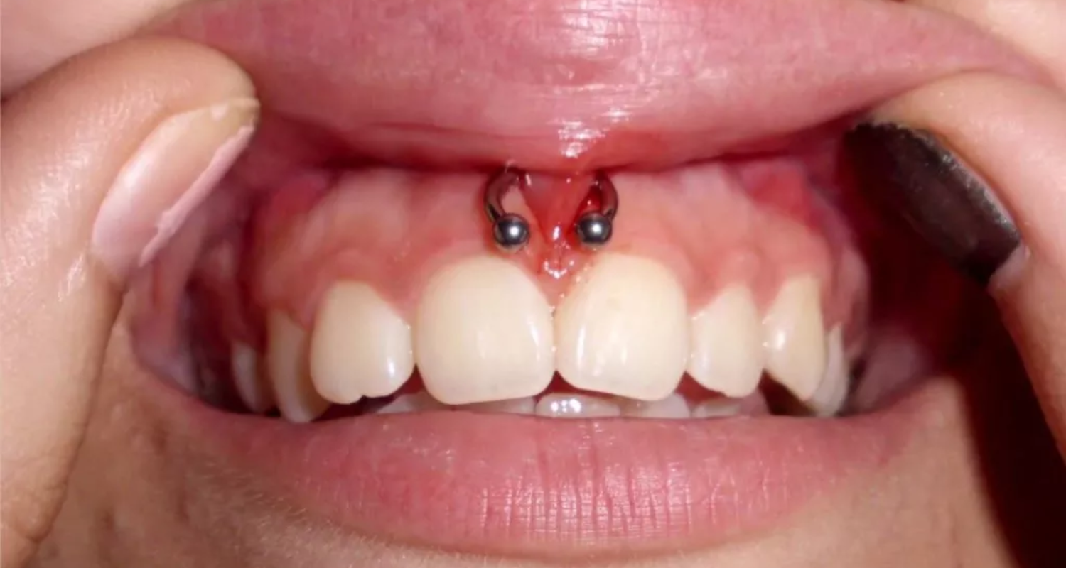 4 - Riesgos de los piercings en la boca