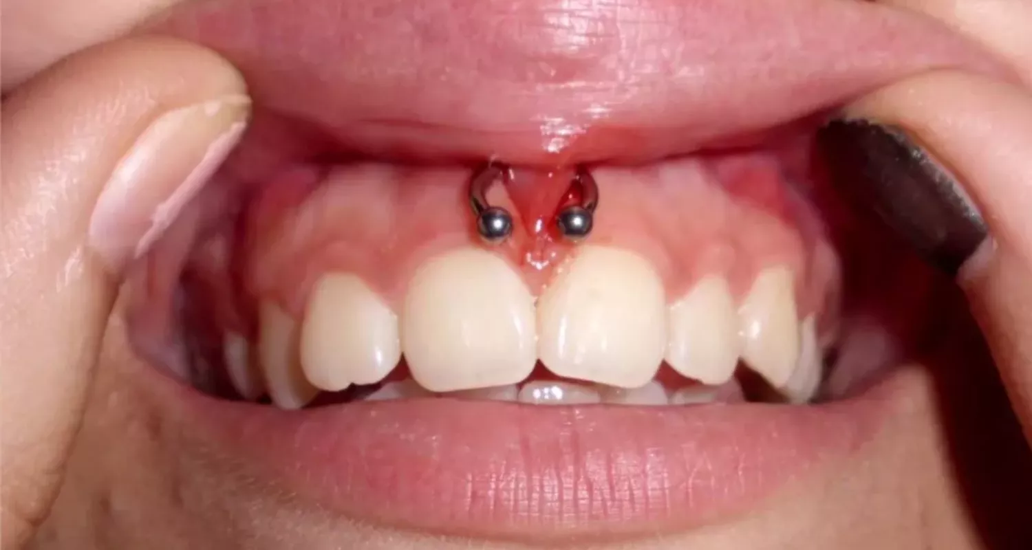 Piercings en la boca: Tipos, riesgos y consejos de cuidado 11 4 - Riesgos de los piercings en la boca