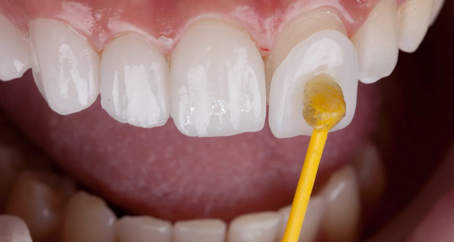 4 - Treatment Options for Peg Teeth