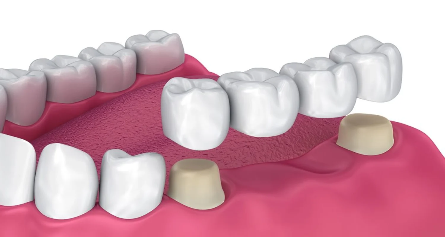 5 - Bridges or partial dentures for milk teeth in adulthood