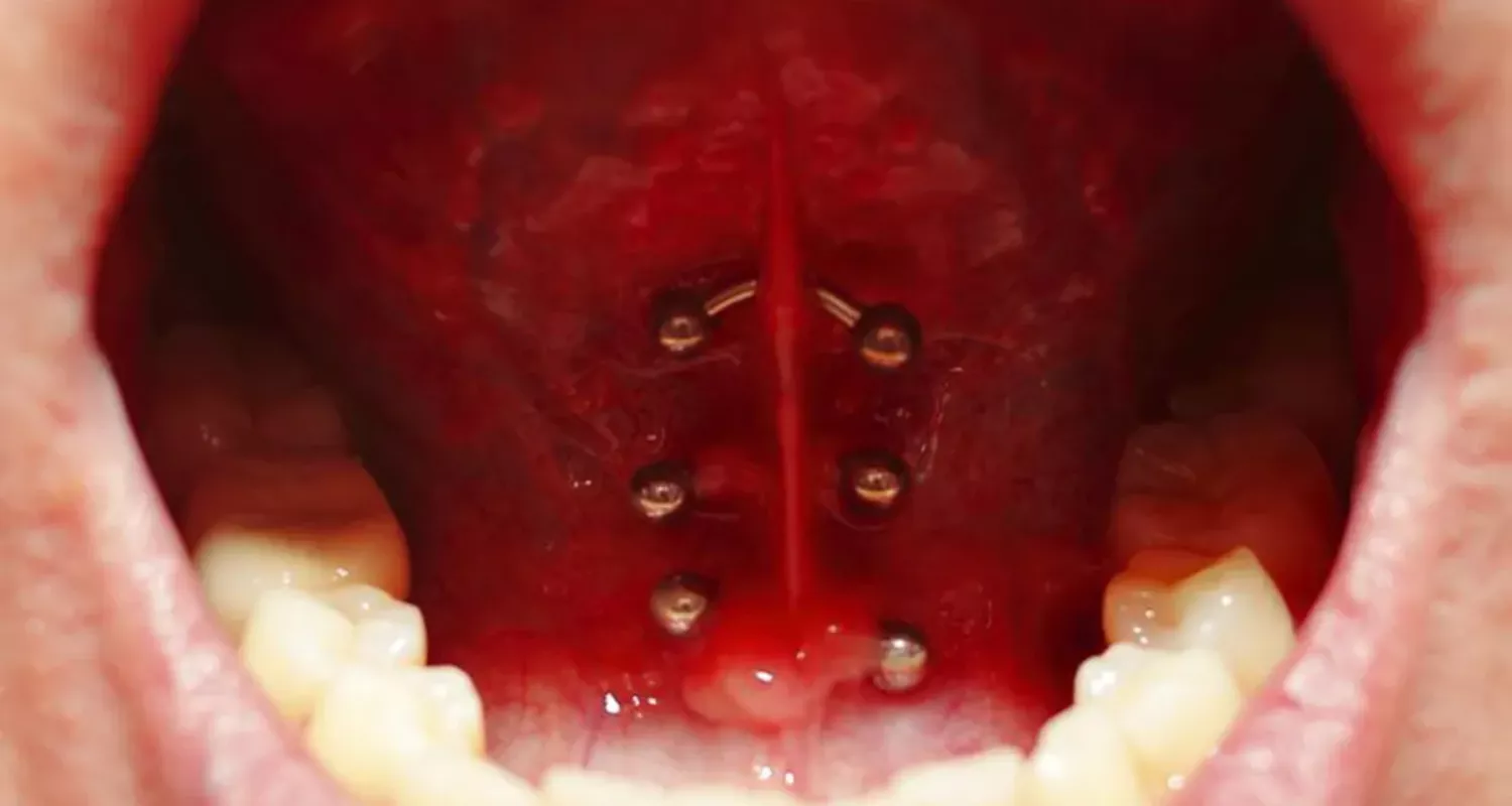 Piercings en la boca: Tipos, riesgos y consejos de cuidado 12 5 - Complicaciones graves tras la colocación de piercings en la boca