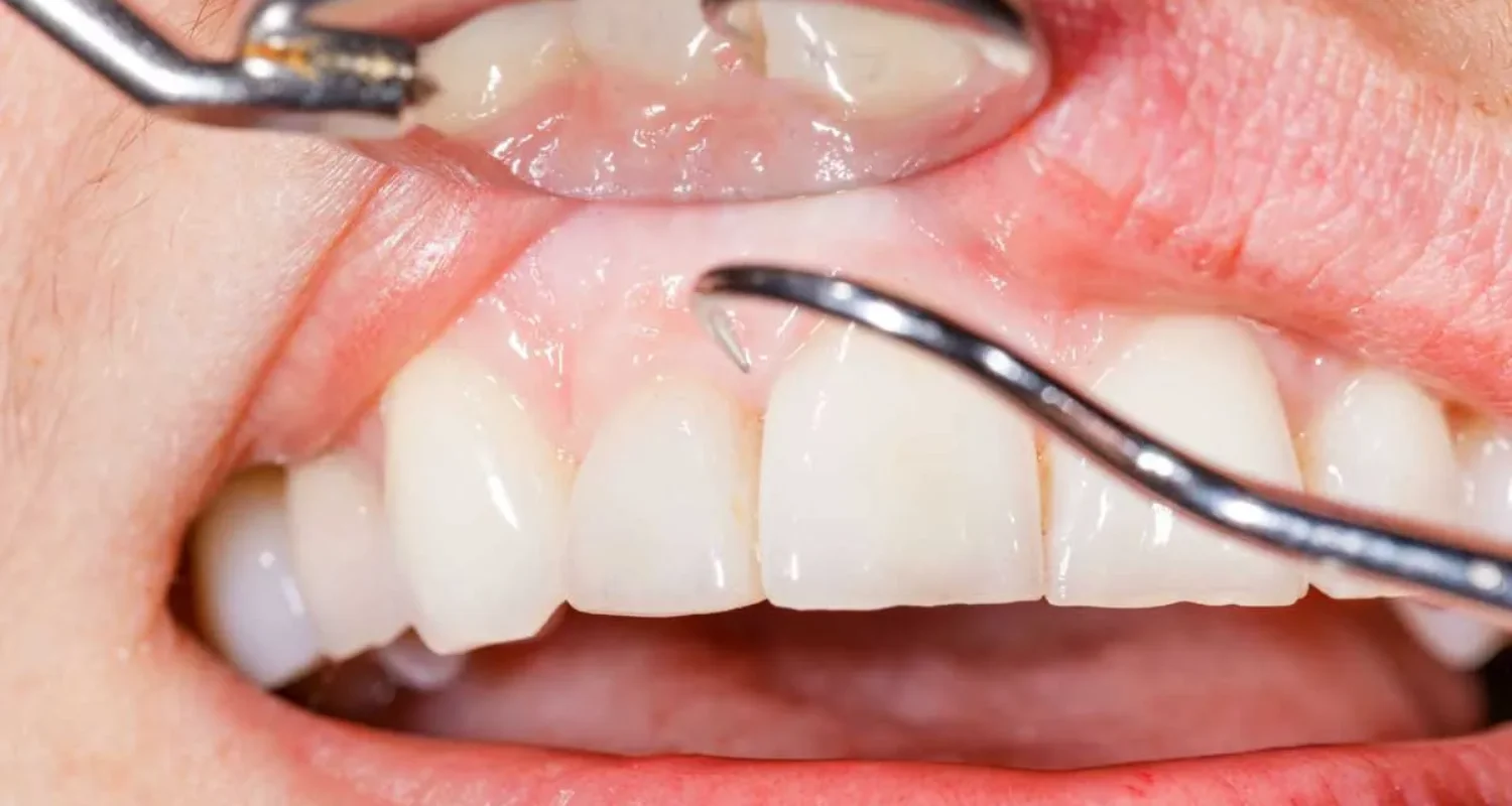 5 - Otras causas de dolor dental que no involucran el nervio