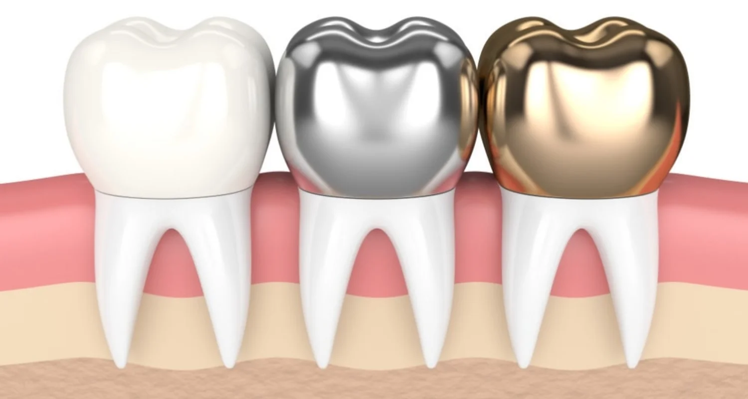 5 - Tratamientos para mejorar los dientes en clavija