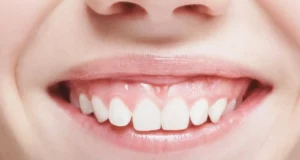 1 - Gummy Smile_ Treatments, Risks, and Oral Care Tips