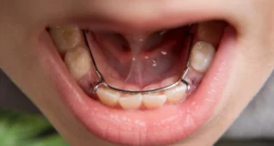 Interceptive Orthodontic Treatment: When is it Needed?