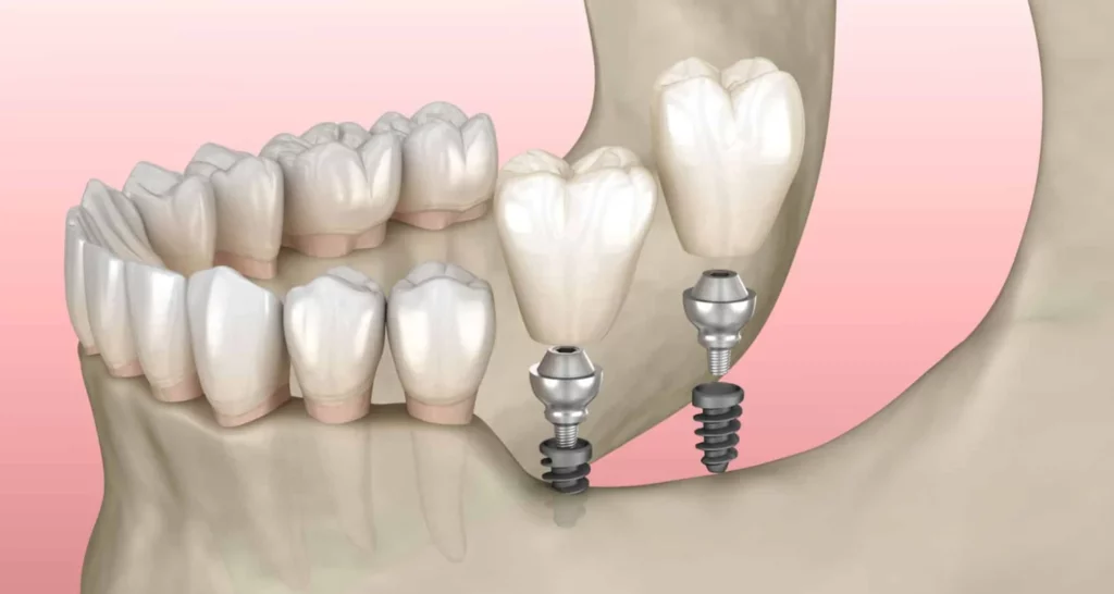 1 - Miniimplante dental_ usos, beneficios y cuidados