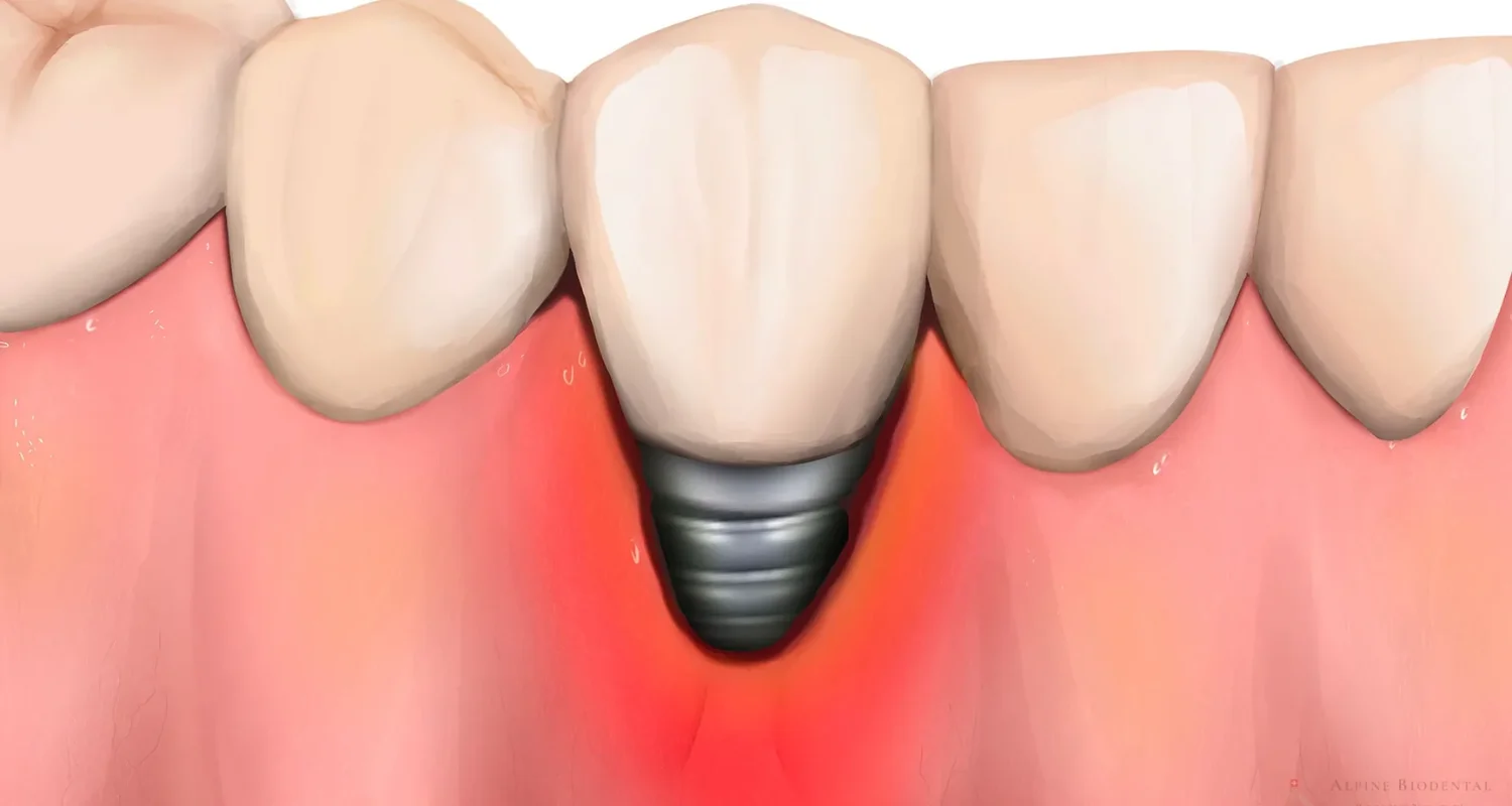 1 - Qué es la periimplantitis y cómo prevenirla eficazmente