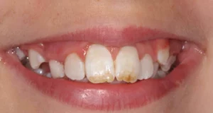 1 - Smoking Teeth Stains_ Safe Ways to Remove Them Fast