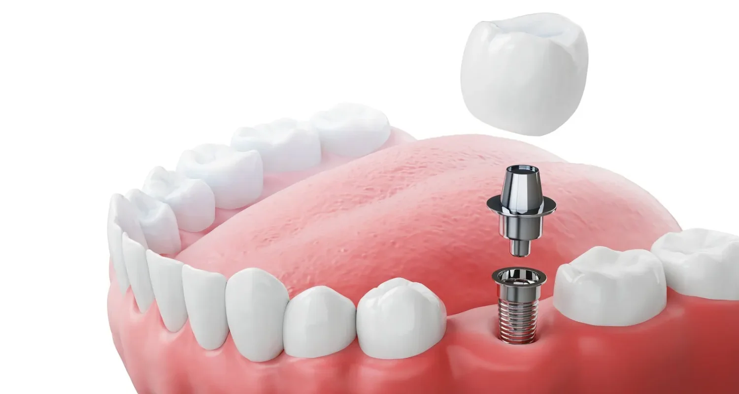 What Are Mini Dental Implants? Key Facts Explained