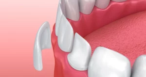 What’s the Difference Between a Veneer and a Crown?