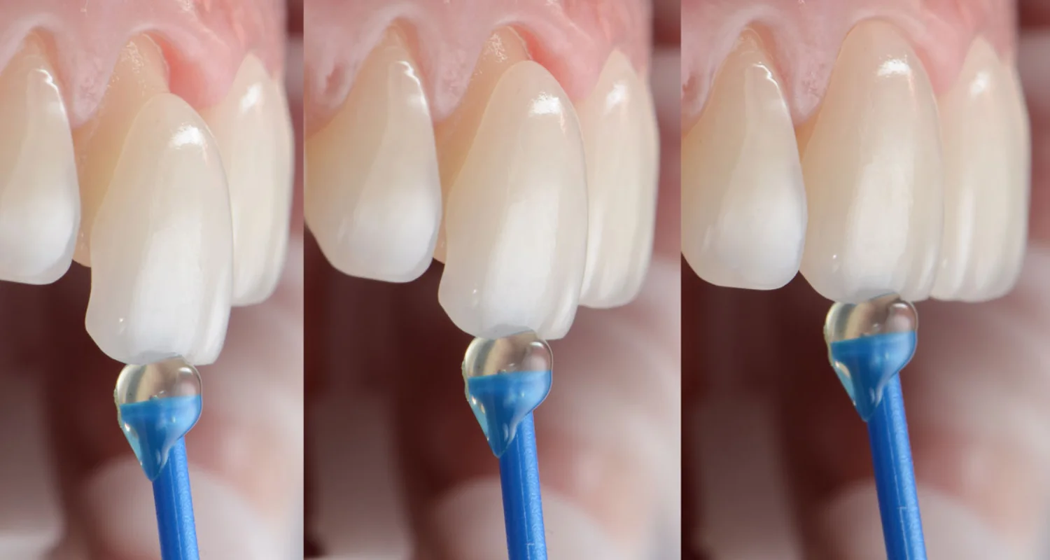 2 - ¿Cuál es la diferencia entre carilla y corona dental