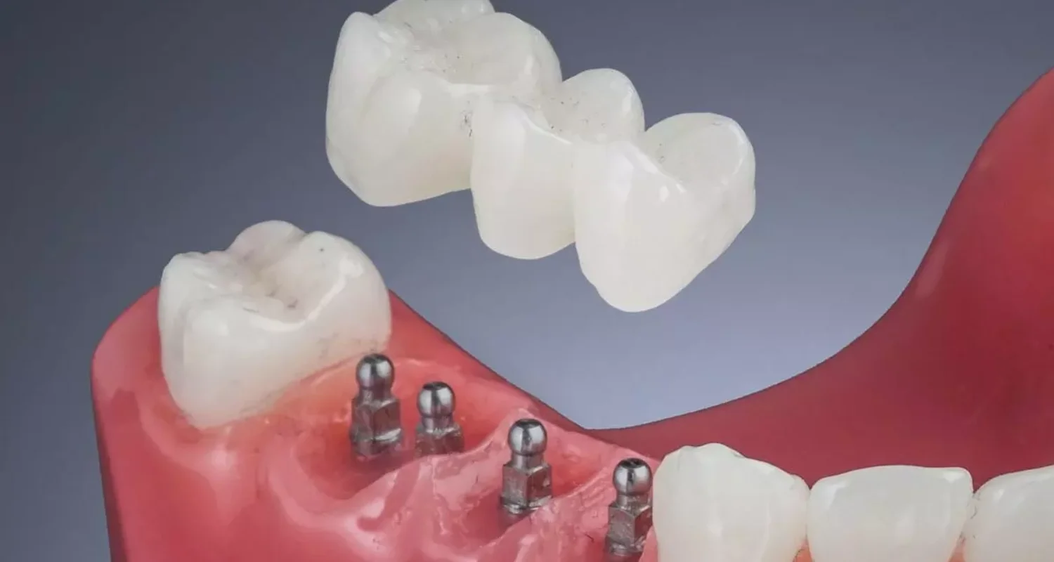 2 - ¿Qué es un miniimplante dental