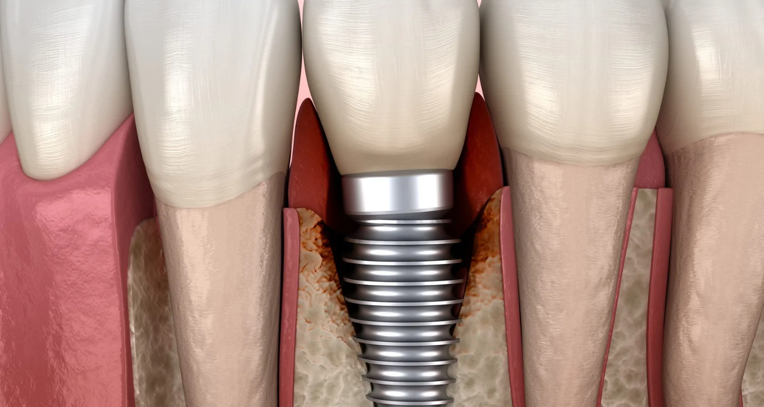 2 - Empecemos por lo esencial_ ¿Que es un implante dental_ - qué es la periimplantitis