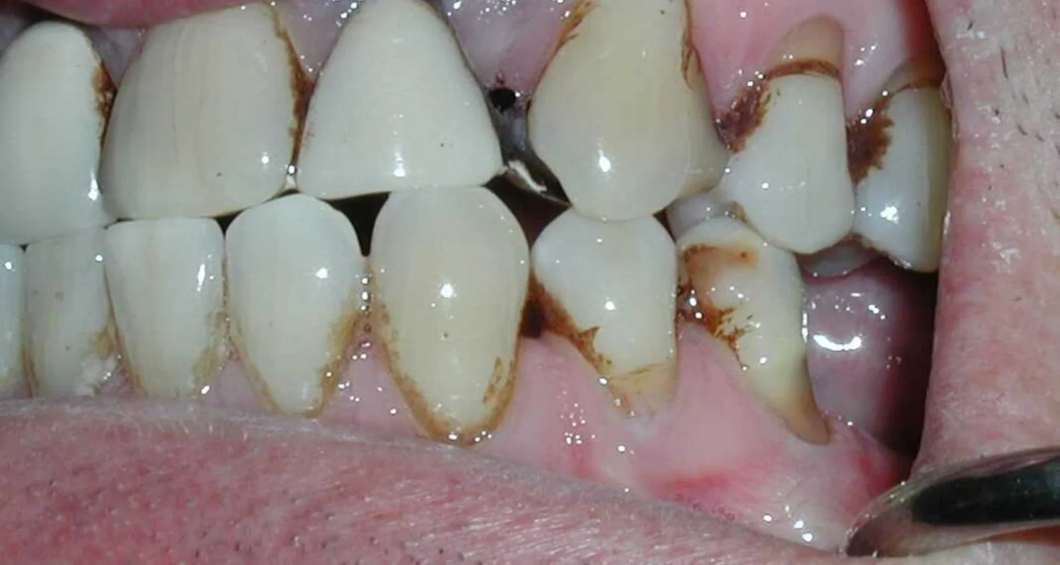 2 - How does smoking cause teeth stains - smoking teeth stains