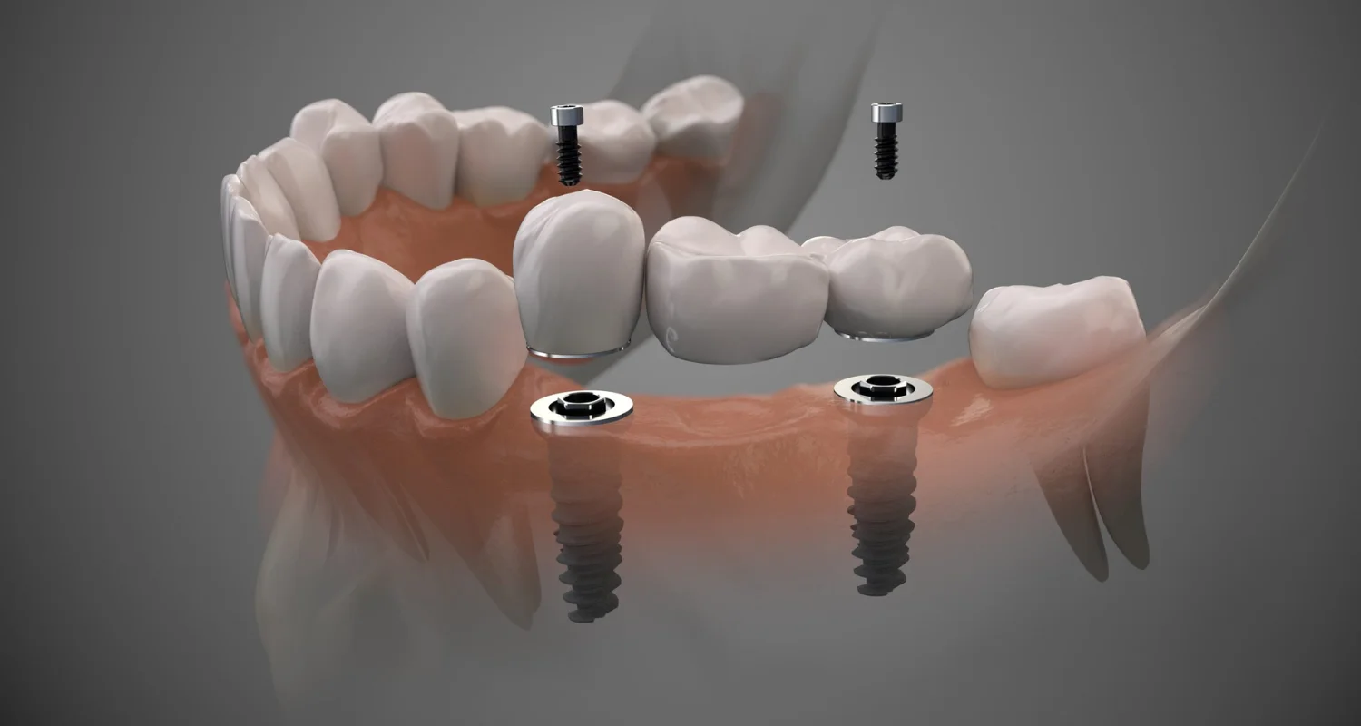 2 - How long does the pain last after dental implants_ - aftercare for dental implants