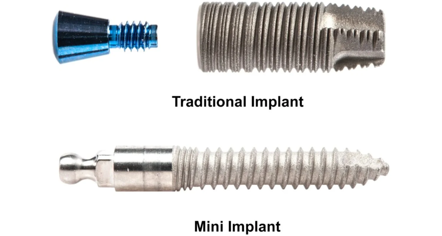 2 - What are mini dental implants