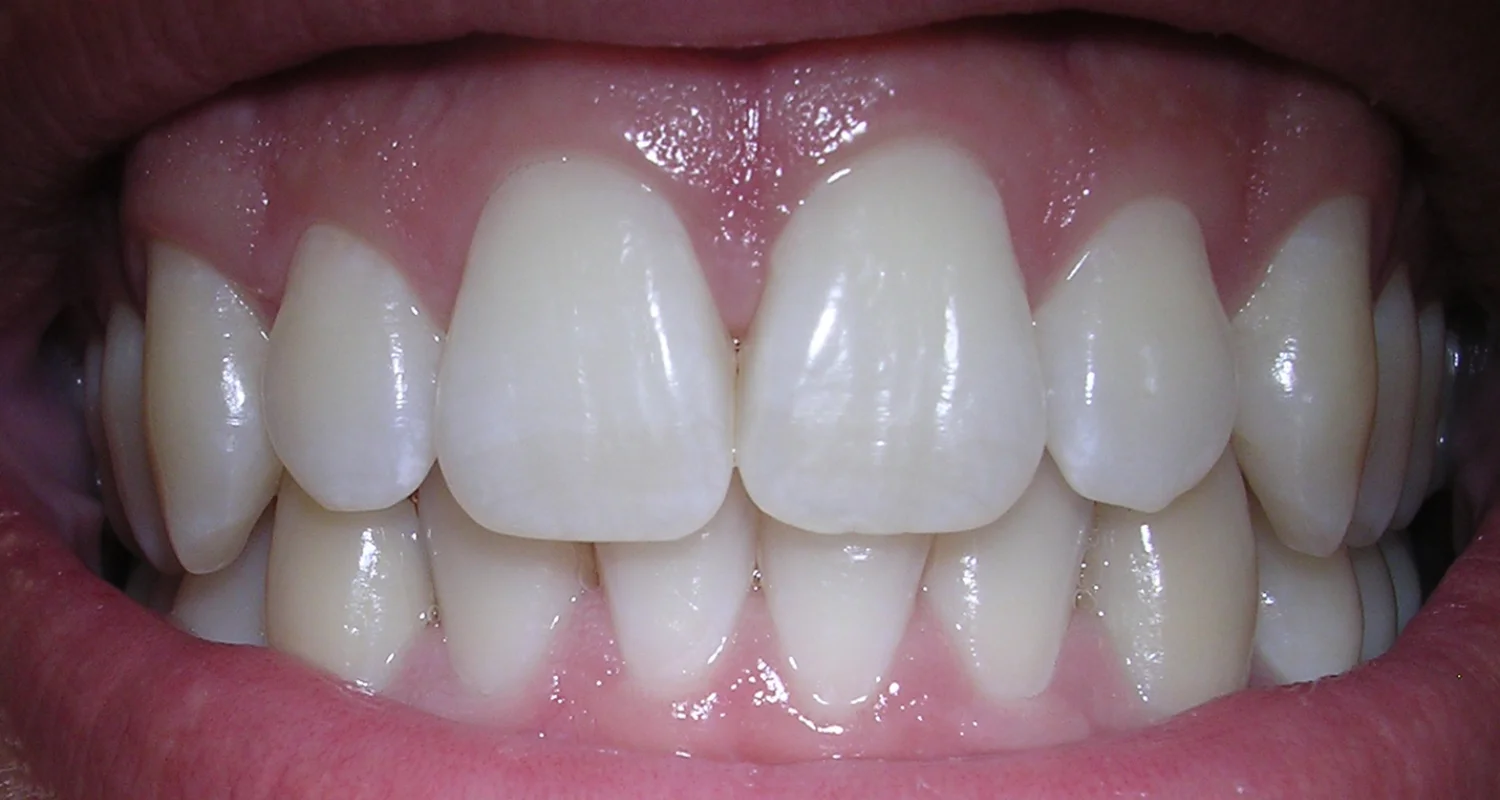 2 - What determines the natural color of teeth