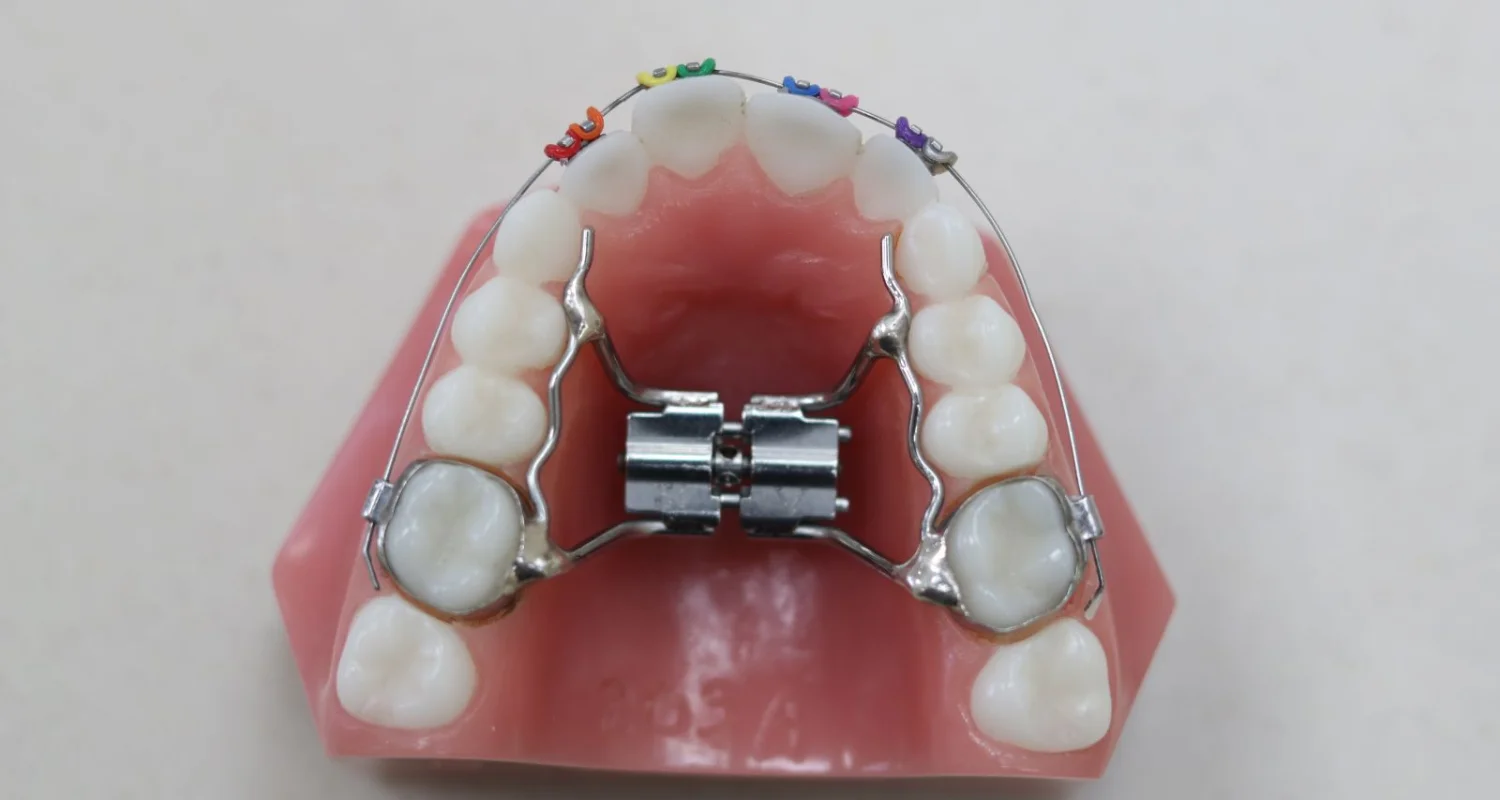 2 - What is a palatal expander for adults