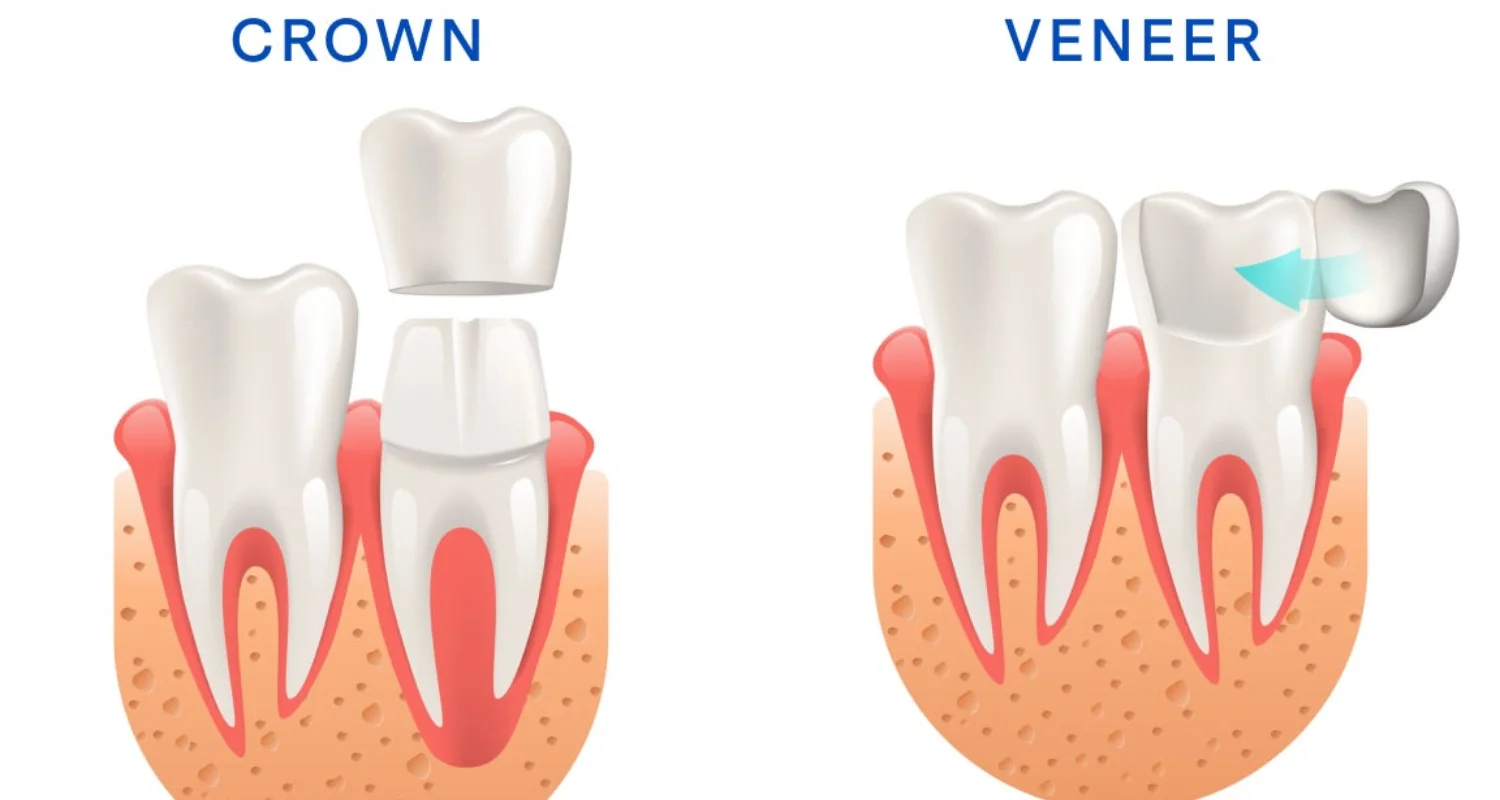 2 - What is the difference between a veneer and a crown