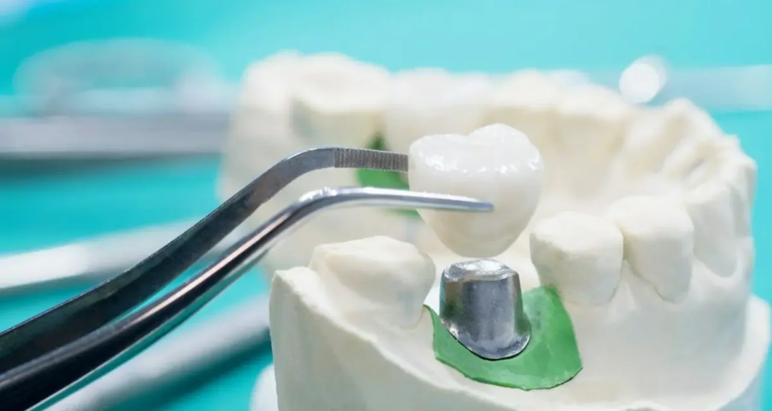 3 - ¿Qué es una corona_ - diferencia entre carilla y corona dental