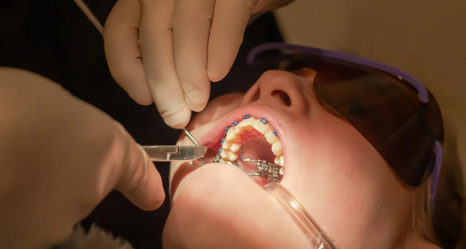 3 - Bone response - palatal expander for adults